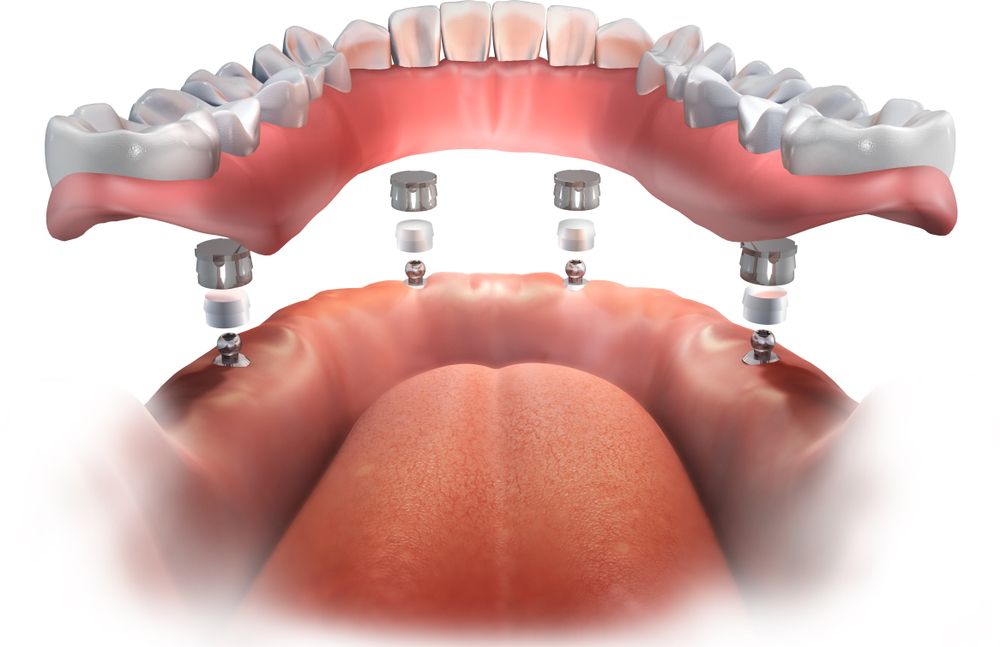 dental implant