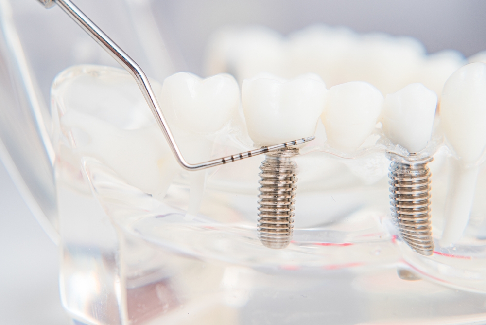 dental implant