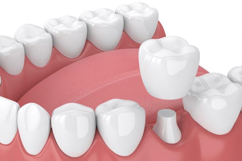 Dental Crowns in Brandywine