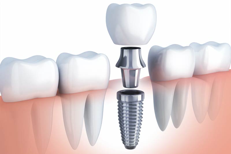 Implants Dentist in Brandywine