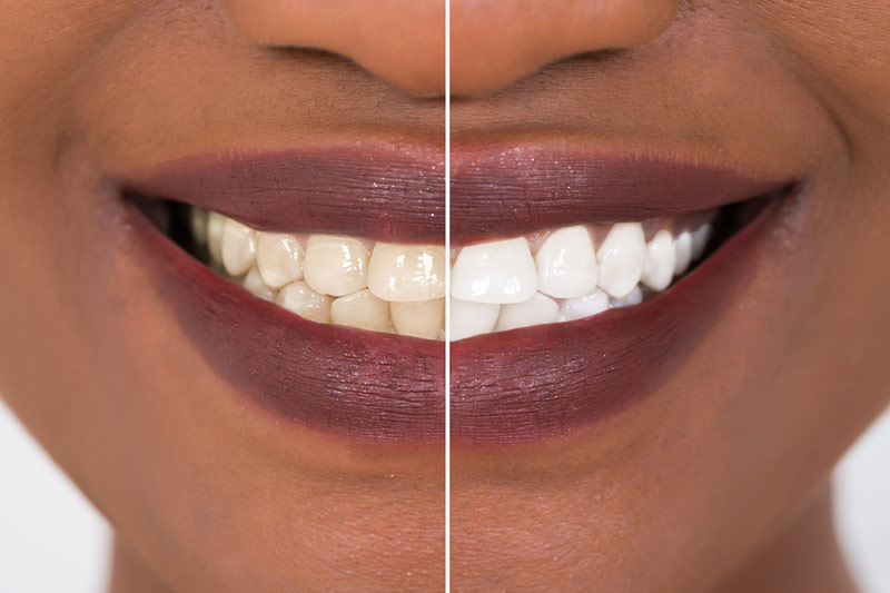 Teeth Whitening in Brandywine
