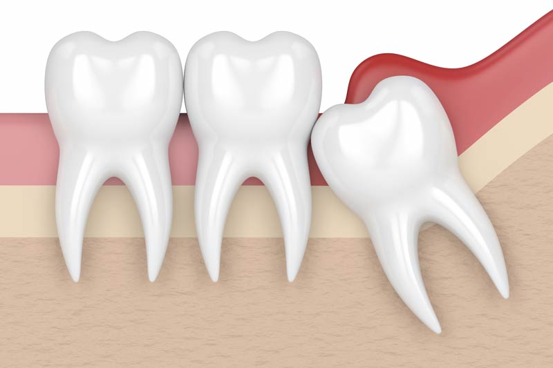 Wisdom Tooth Removal in Brandywine
